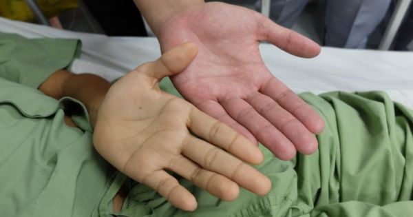 Bajo Rendimiento Escolar a Causa de la Anemia